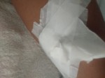 Por falta de esparadrapo, fita gomada Ã© usada para fazer curativos no Hospital TarcÃ­sio Maia