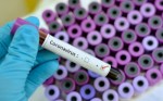 1Âº caso oficial de reinfecÃ§Ã£o por coronavirus no RN Ã© tratado como o fim do mundo